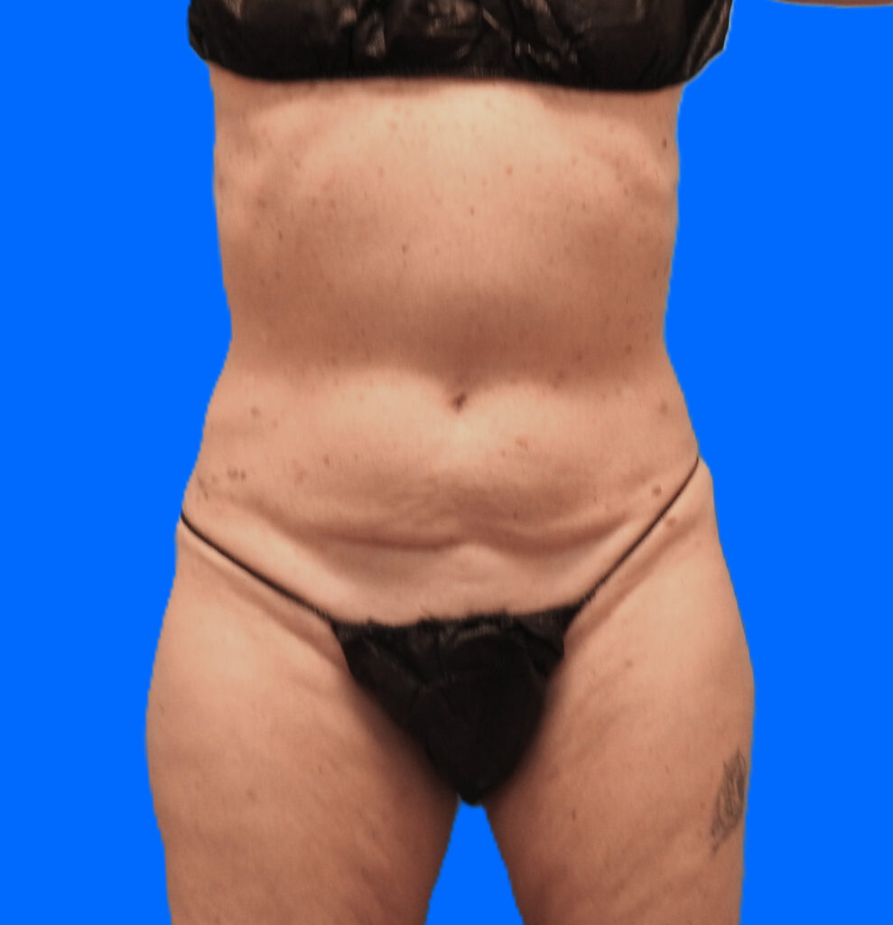 Before Image: Patient Case #795 - front