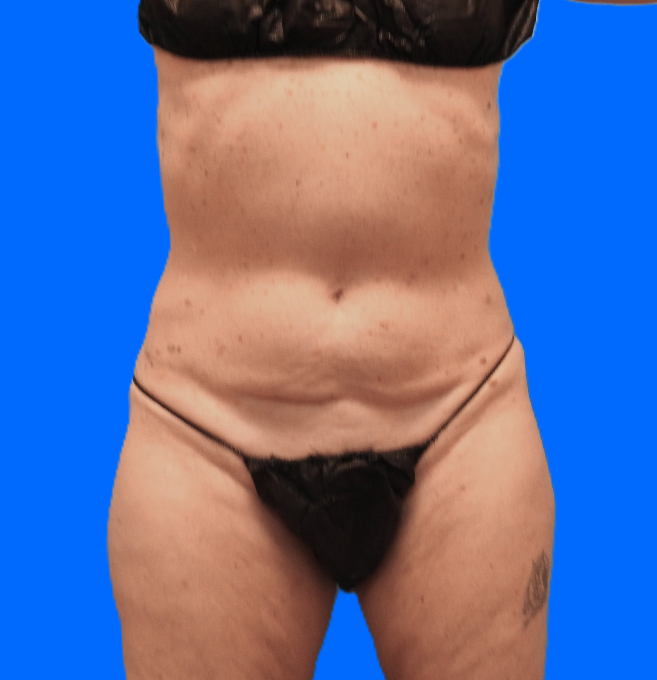 Before Image: Patient Case #795 - front