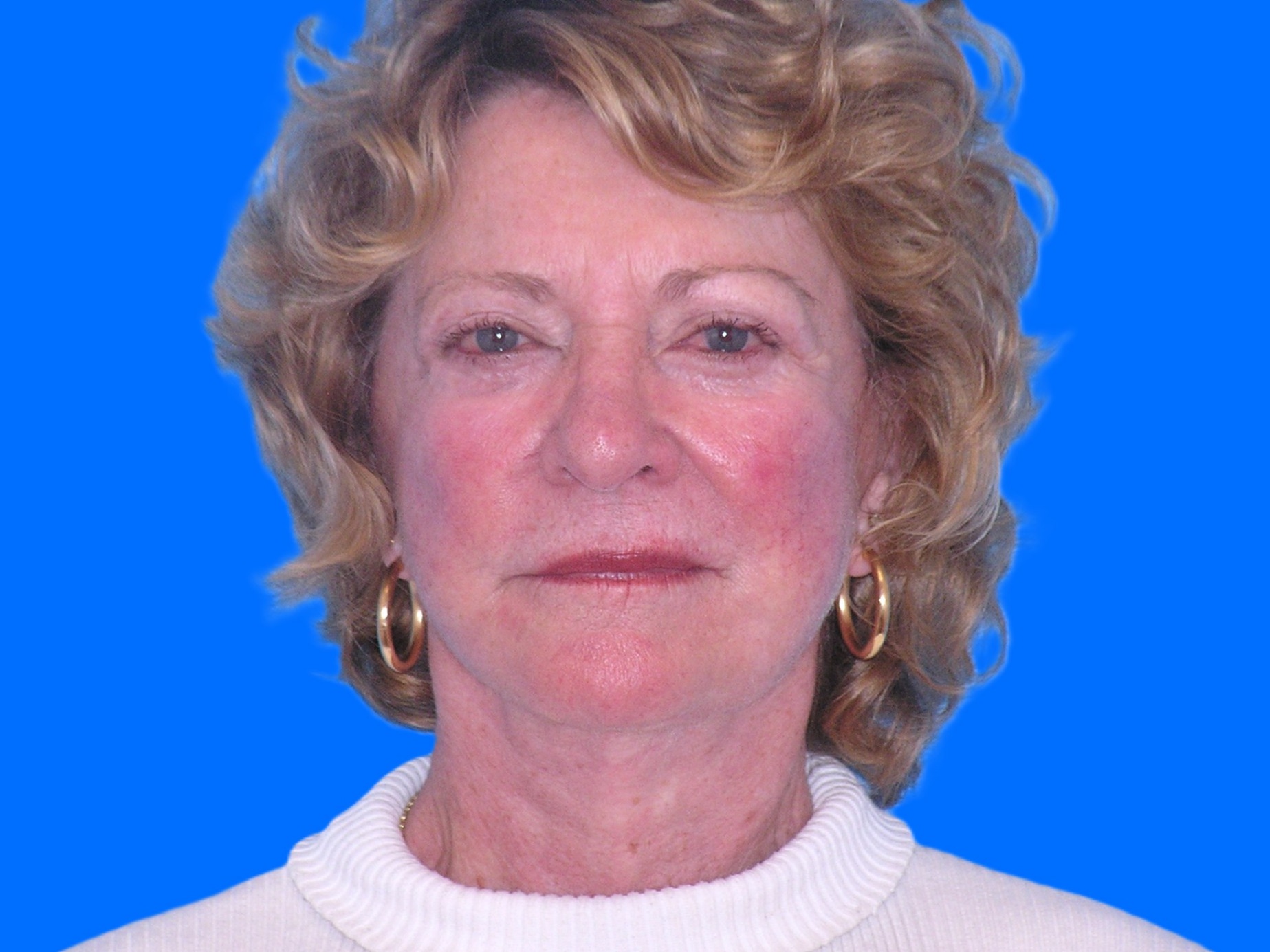 After Image: Patient Case #845 - front