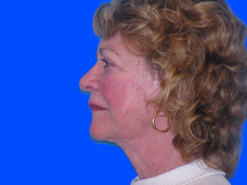 After Image: Patient Case #845 - left-side