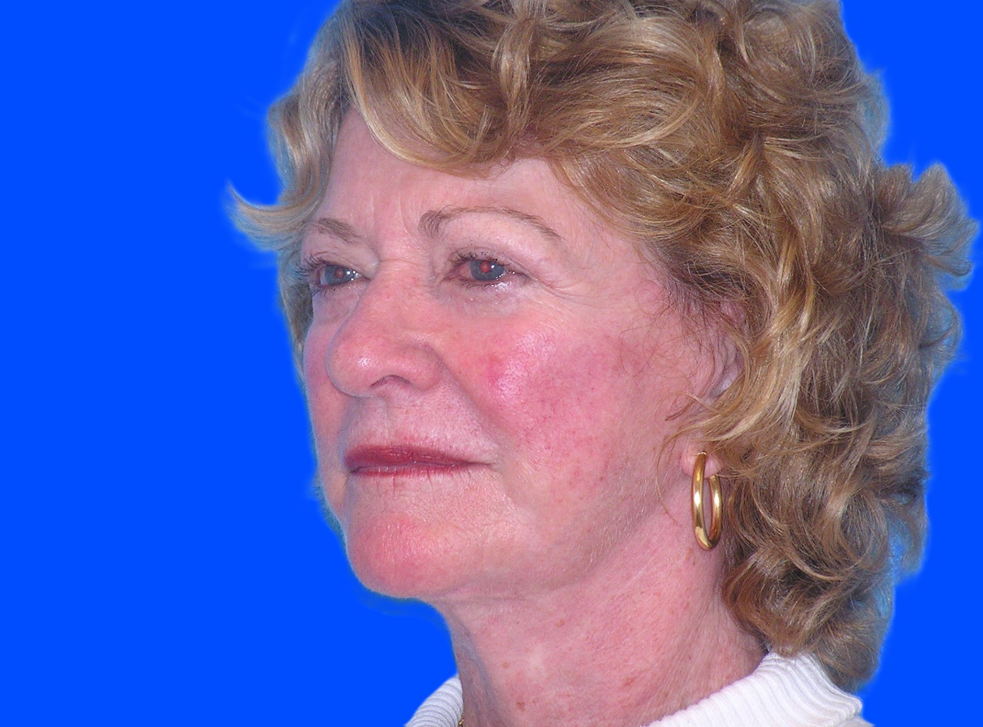 After Image: Patient Case #845 - left-front-oblique