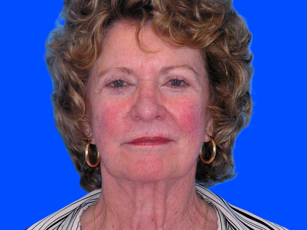 Before Image: Patient Case #845 - front
