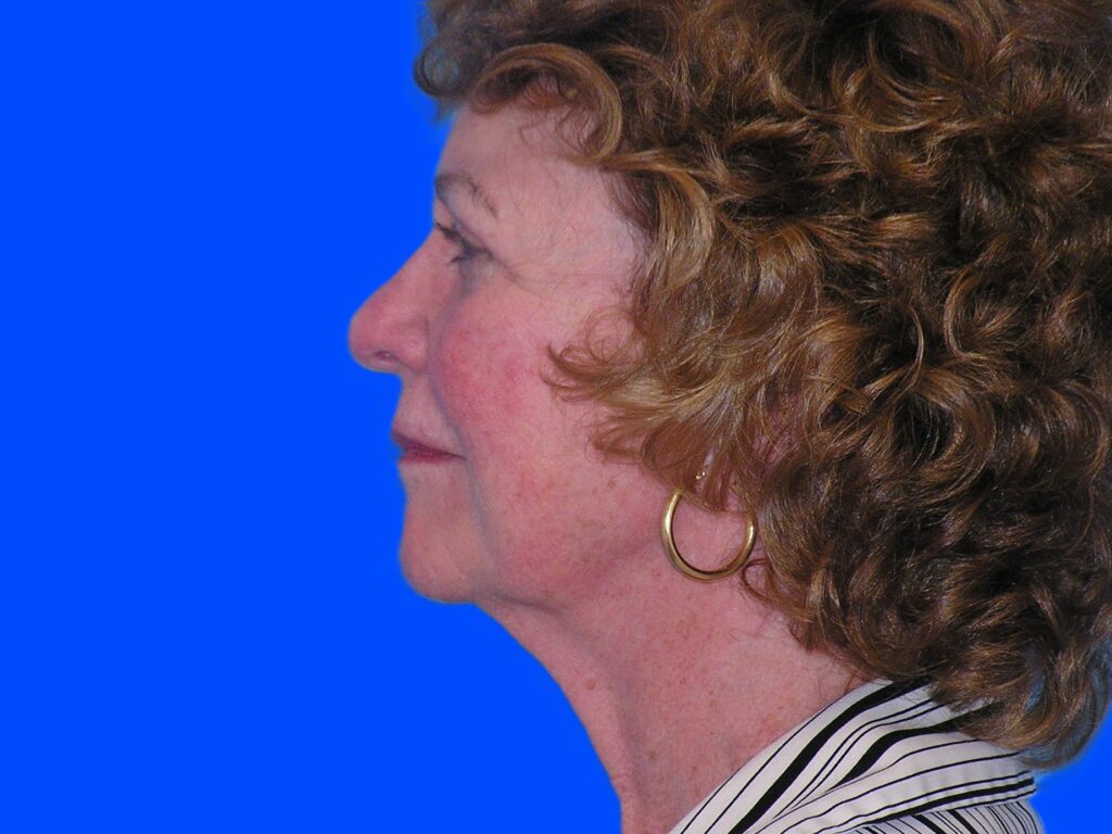 Before Image: Patient Case #845 - left-side