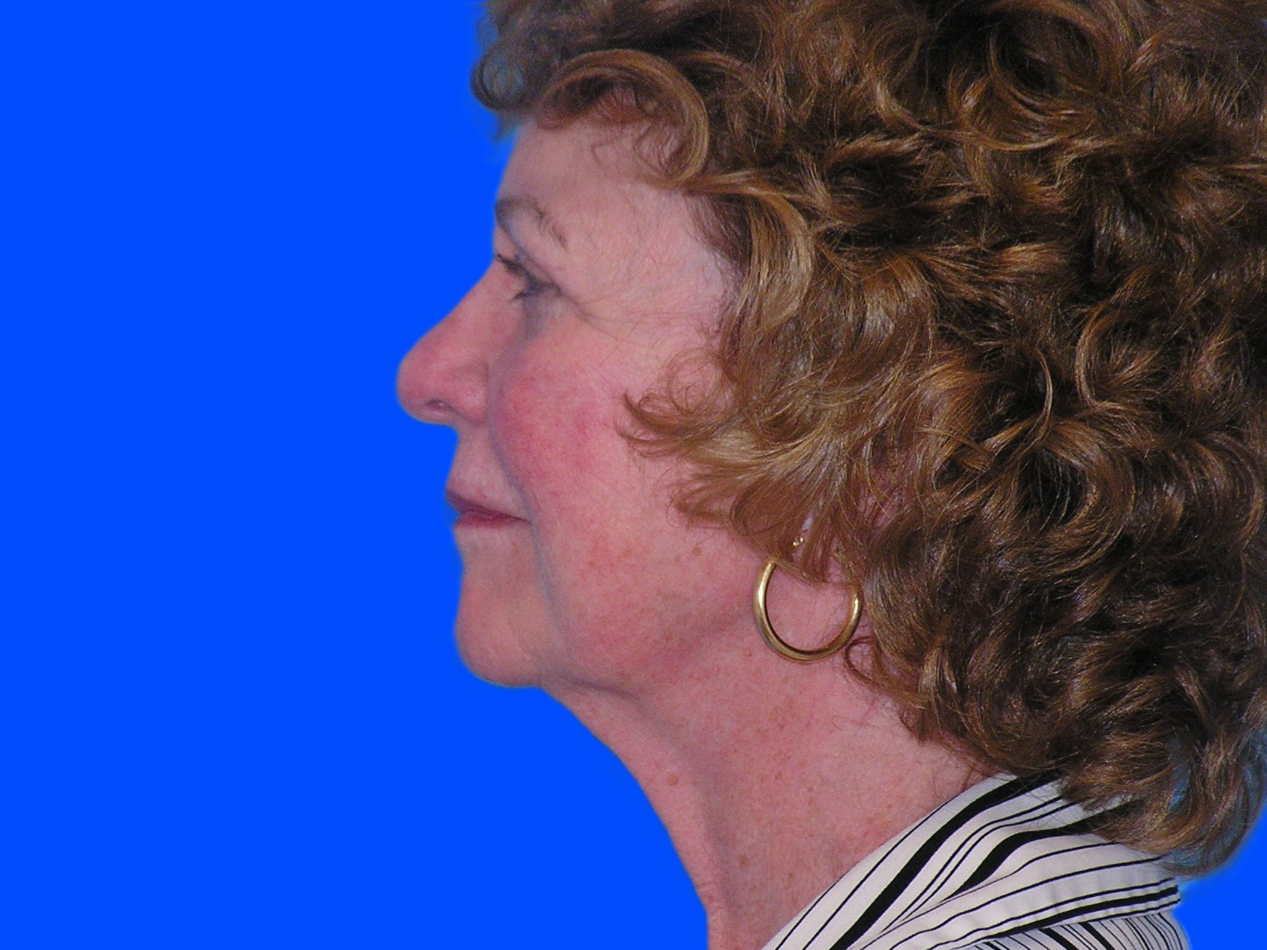 Before Image: Patient Case #845 - left-side