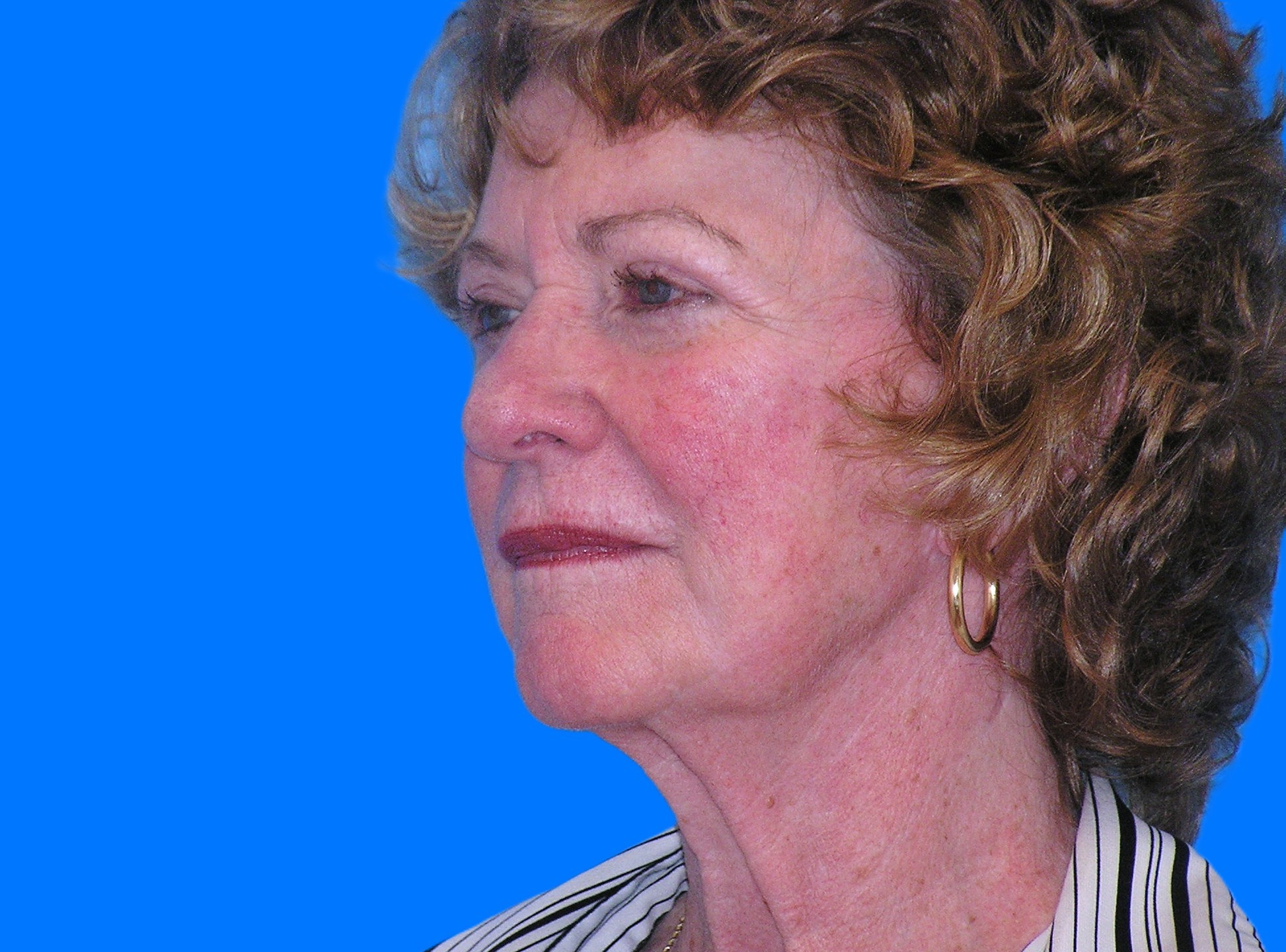 Before Image: Patient Case #845 - left-front-oblique