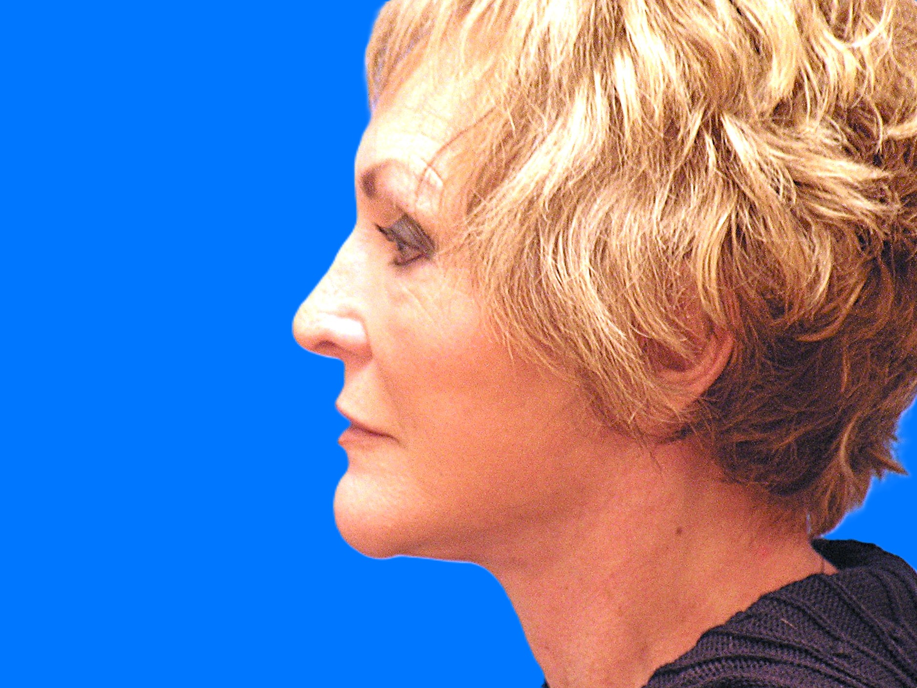 After Image: Patient Case #849 - left-side