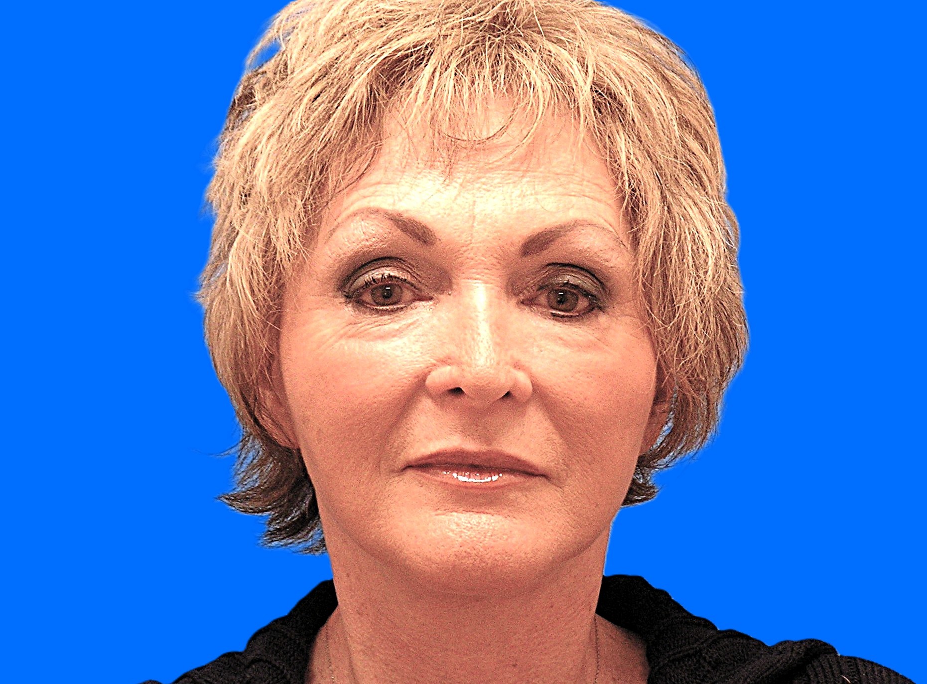 After Image: Patient Case #849 - front