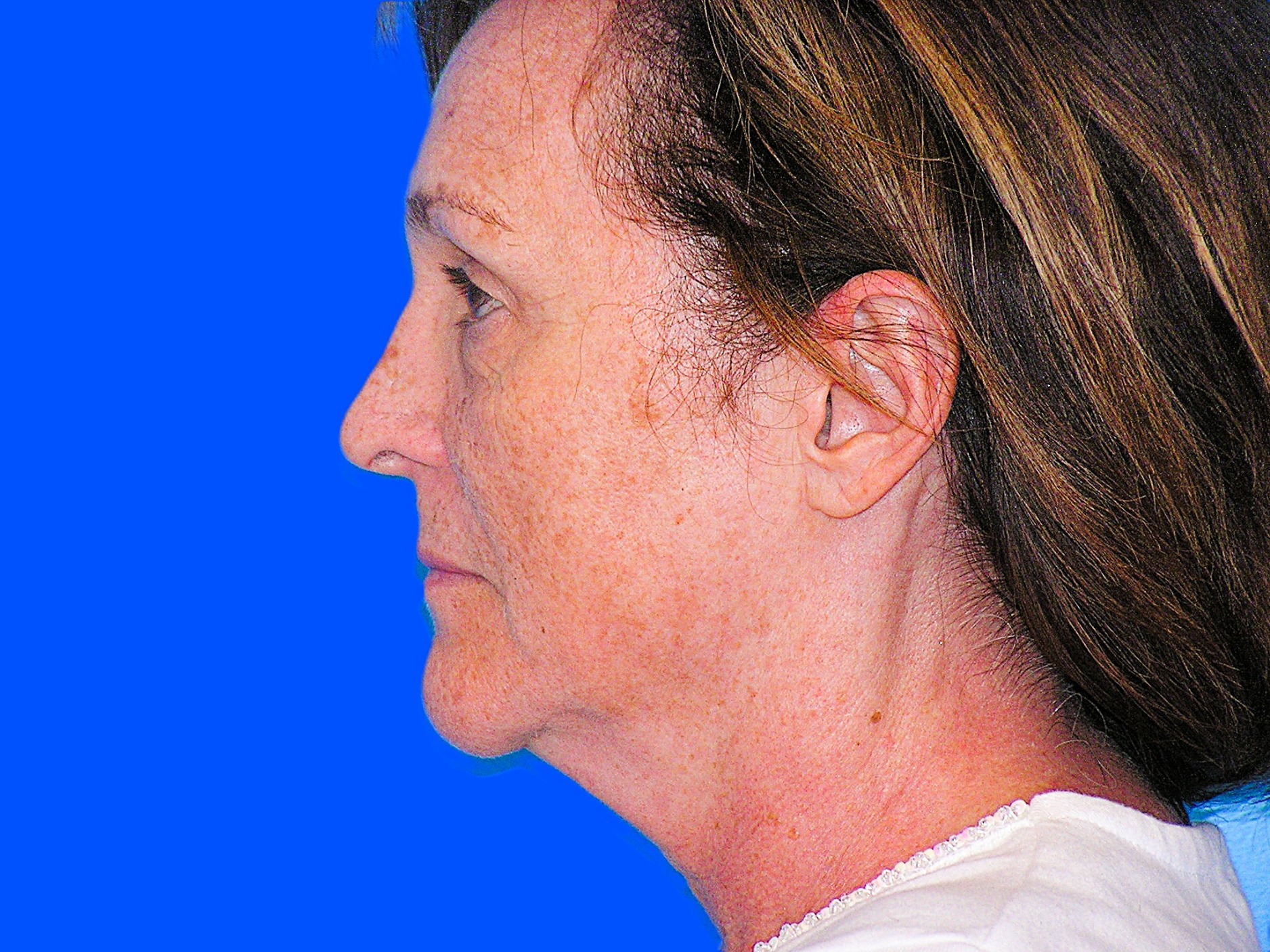 Before Image: Patient Case #849 - left-side