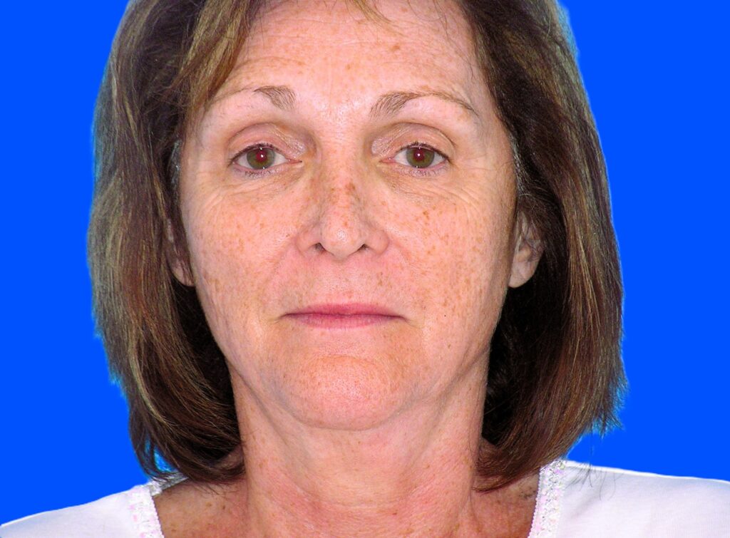 Before Image: Patient Case #849 - front