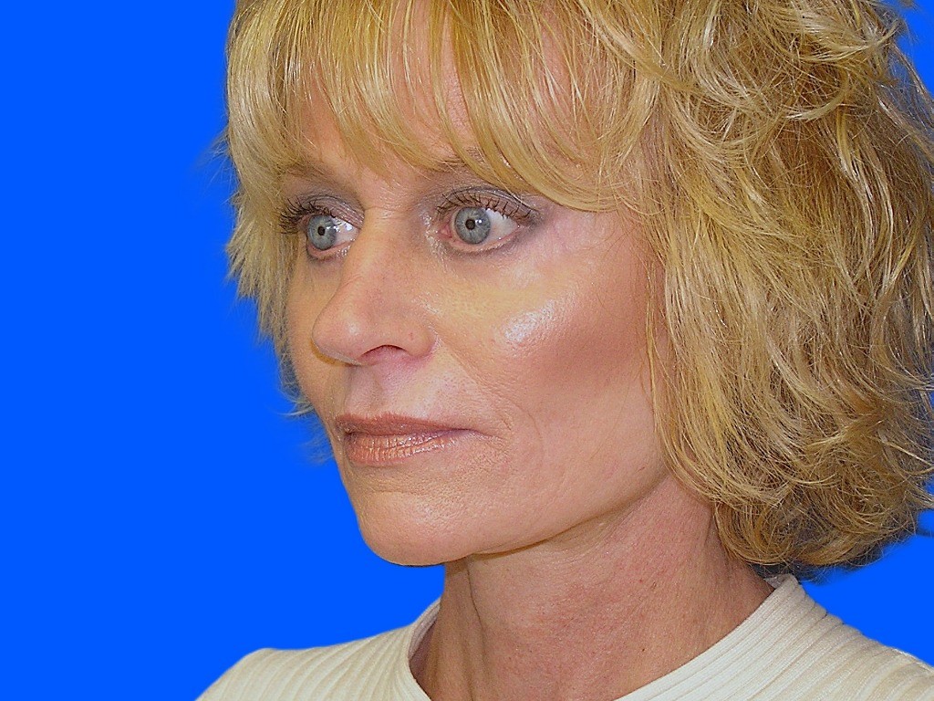 After Image: Patient Case #850 - left-front-oblique