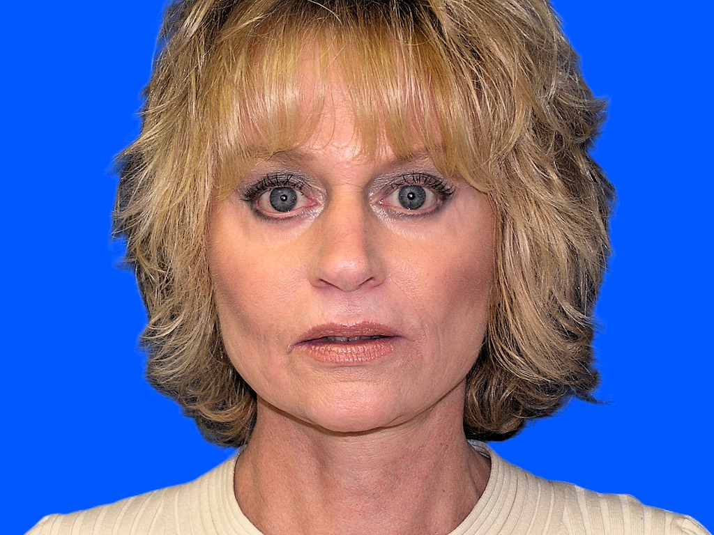 After Image: Patient Case #850 - front