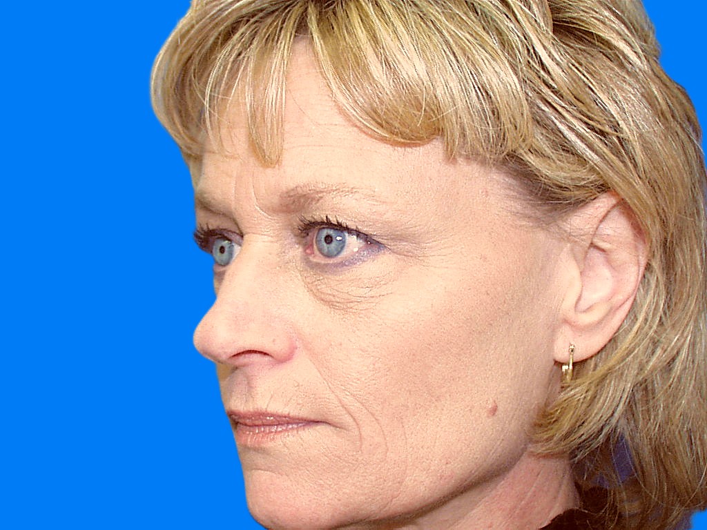 Before Image: Patient Case #850 - left-front-oblique