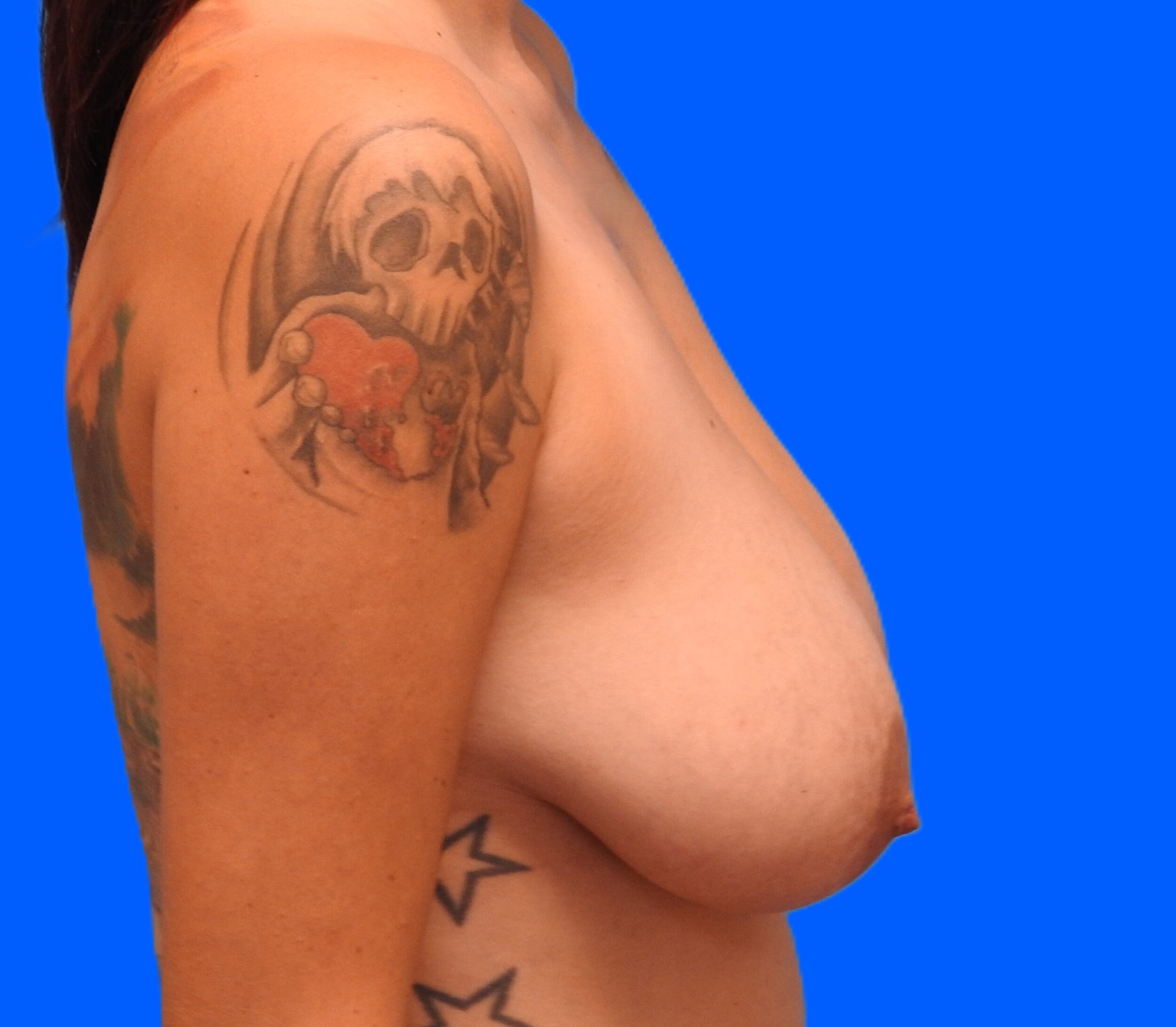 Before Image: Patient Case #850 - right-side