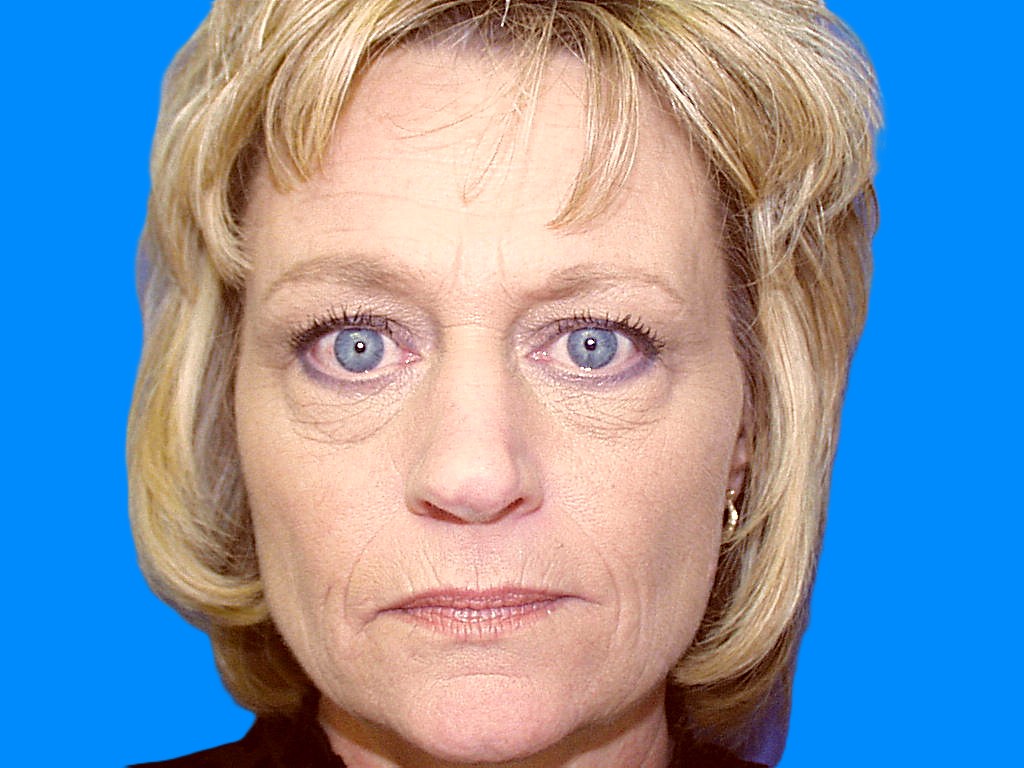 Before Image: Patient Case #850 - front