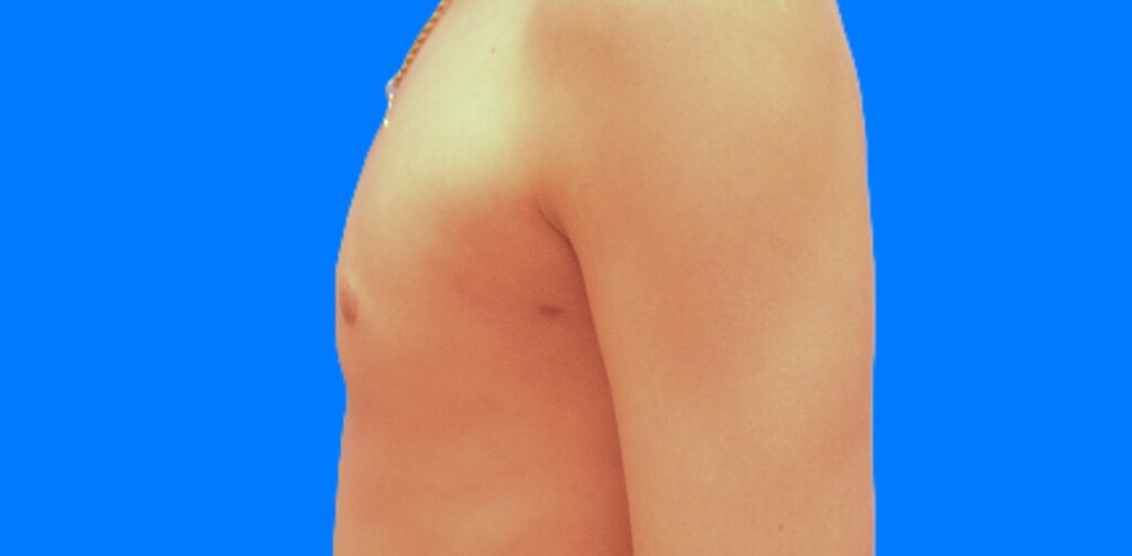 After Image: Patient Case #898 - left-side