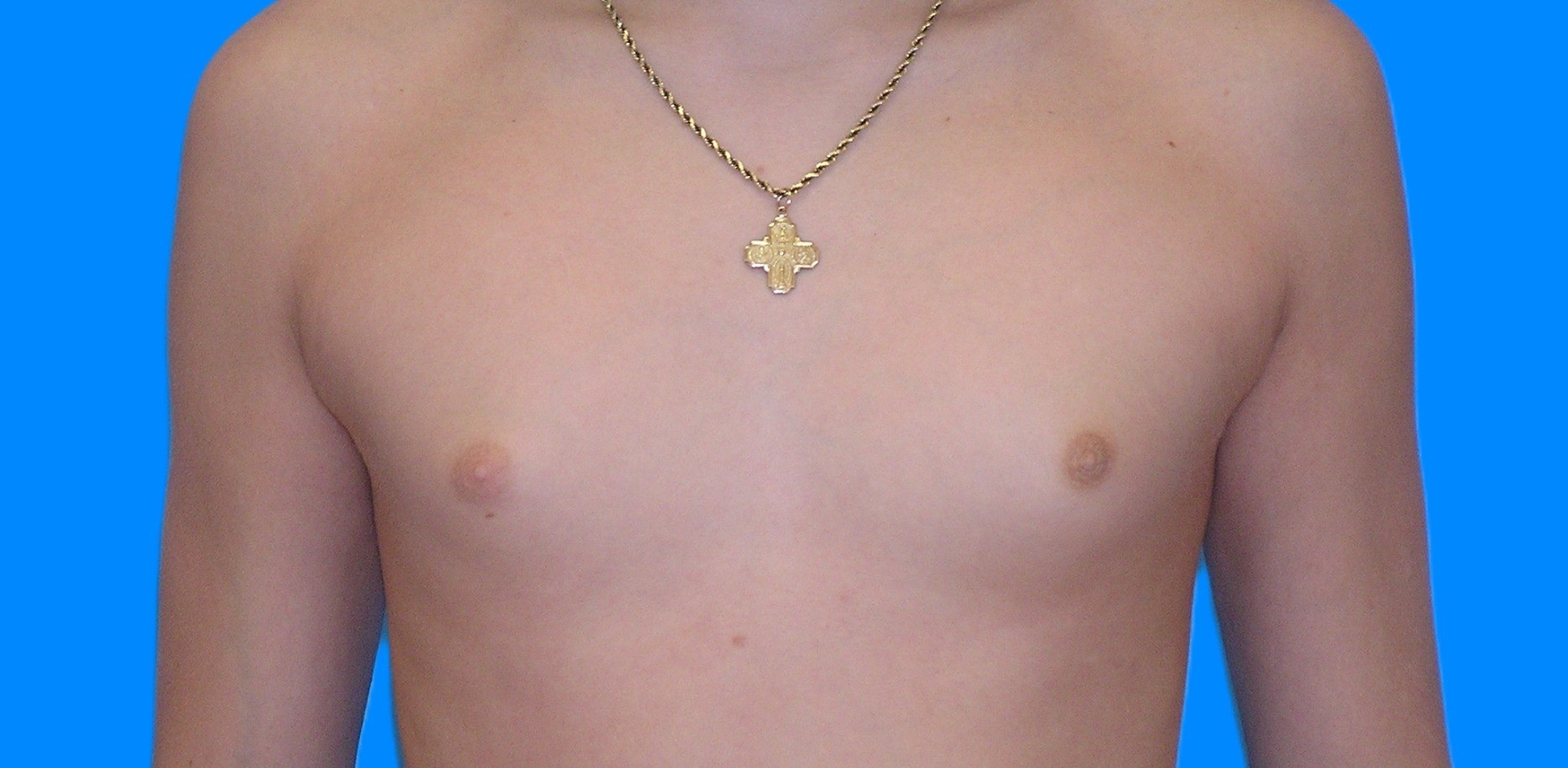 Before Image: Patient Case #898 - front