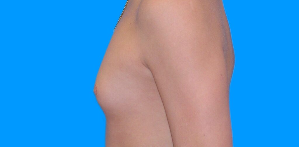 Before Image: Patient Case #898 - left-side