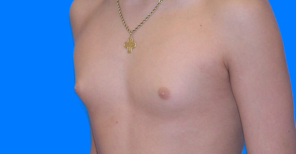 Before Image: Patient Case #898 - left-front-oblique