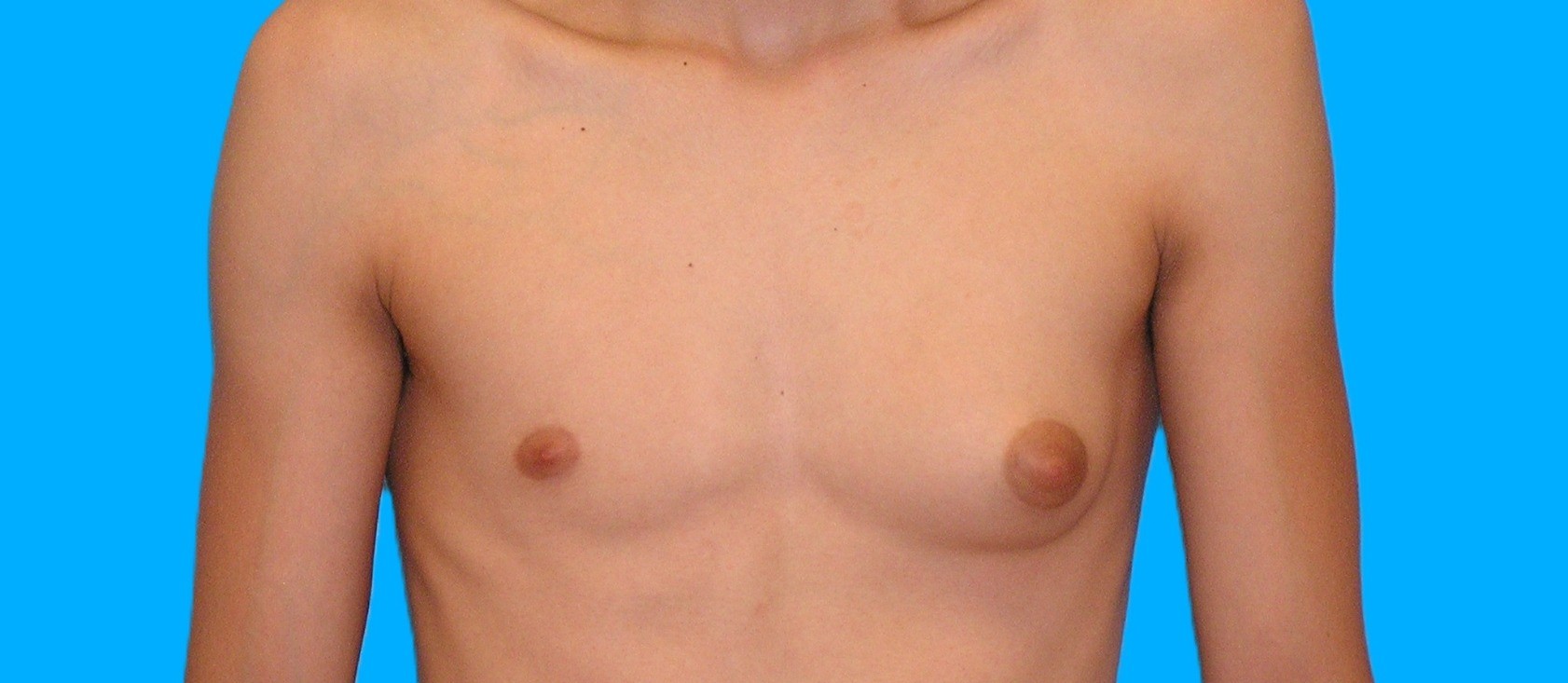 Before Image: Patient Case #899 - front