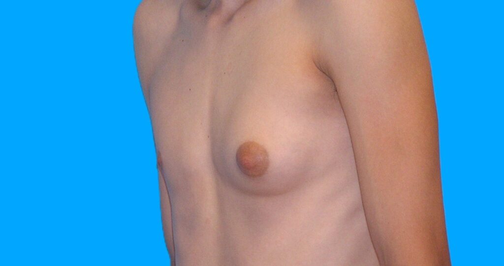 Before Image: Patient Case #899 - left-front-oblique