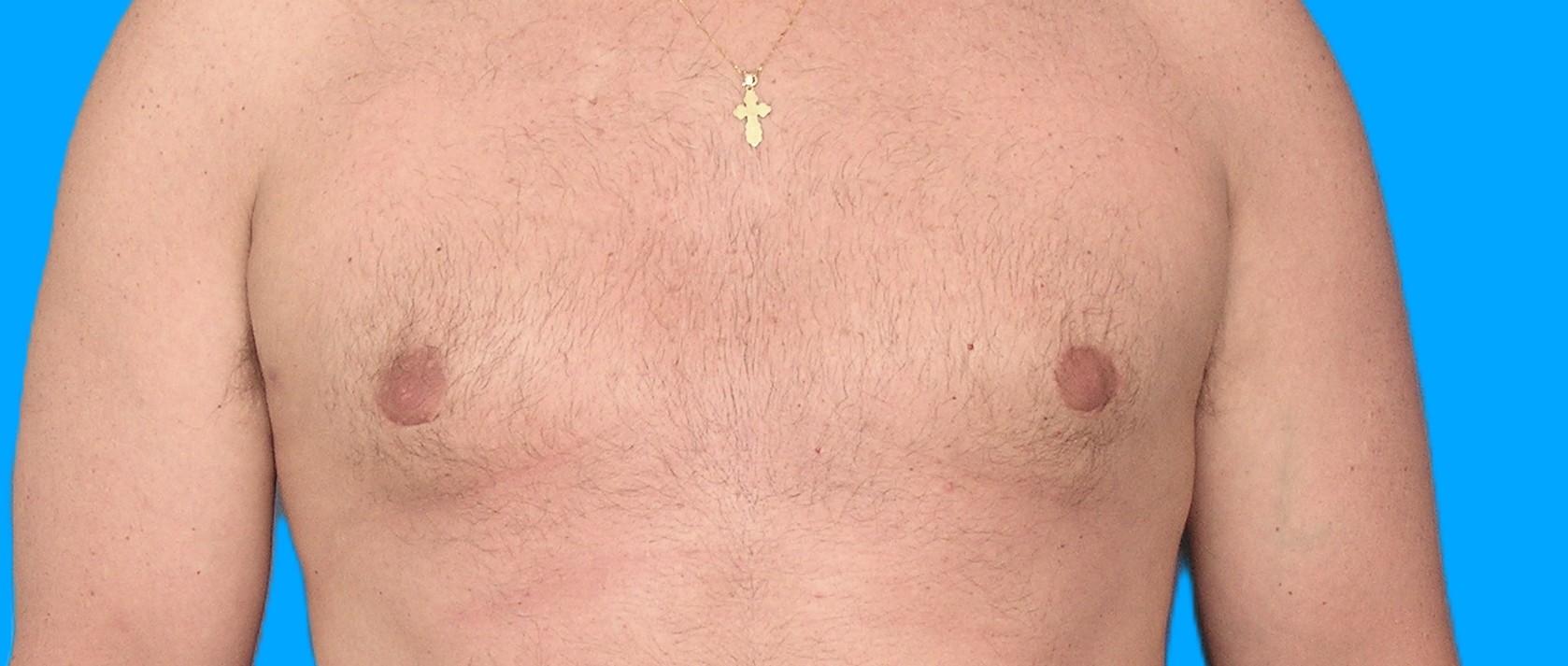 After Image: Patient Case #900 - front