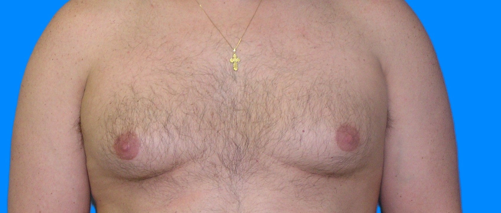 Before Image: Patient Case #900 - front