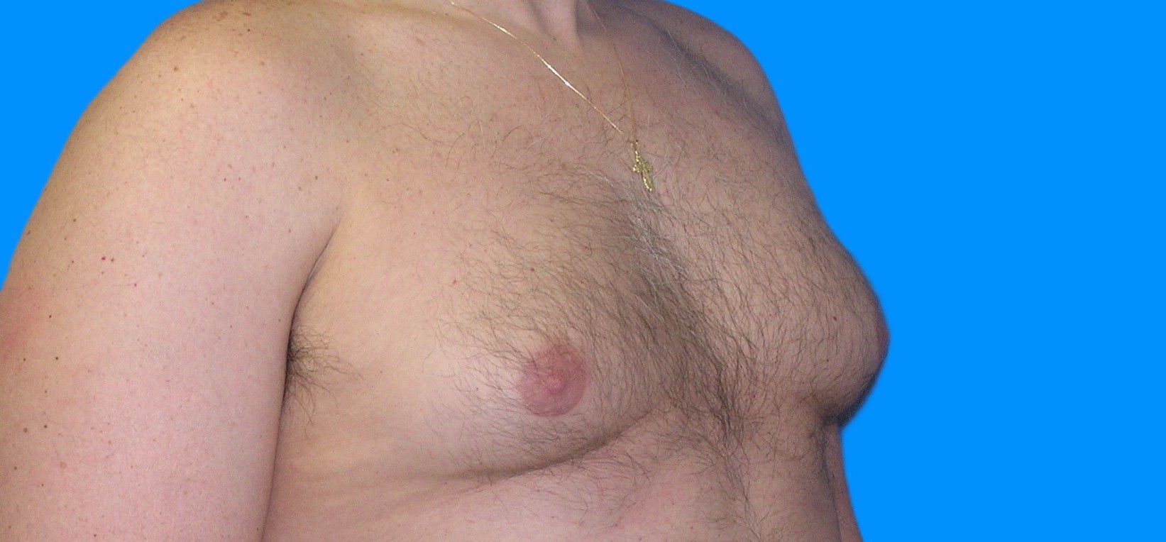 Before Image: Patient Case #900 - right-front-oblique
