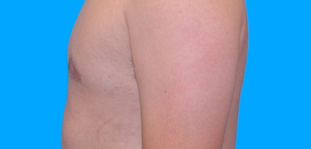 After Image: Patient Case #902 - left-side