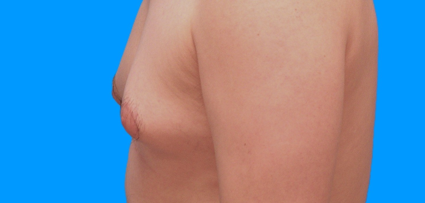 Before Image: Patient Case #902 - left-side