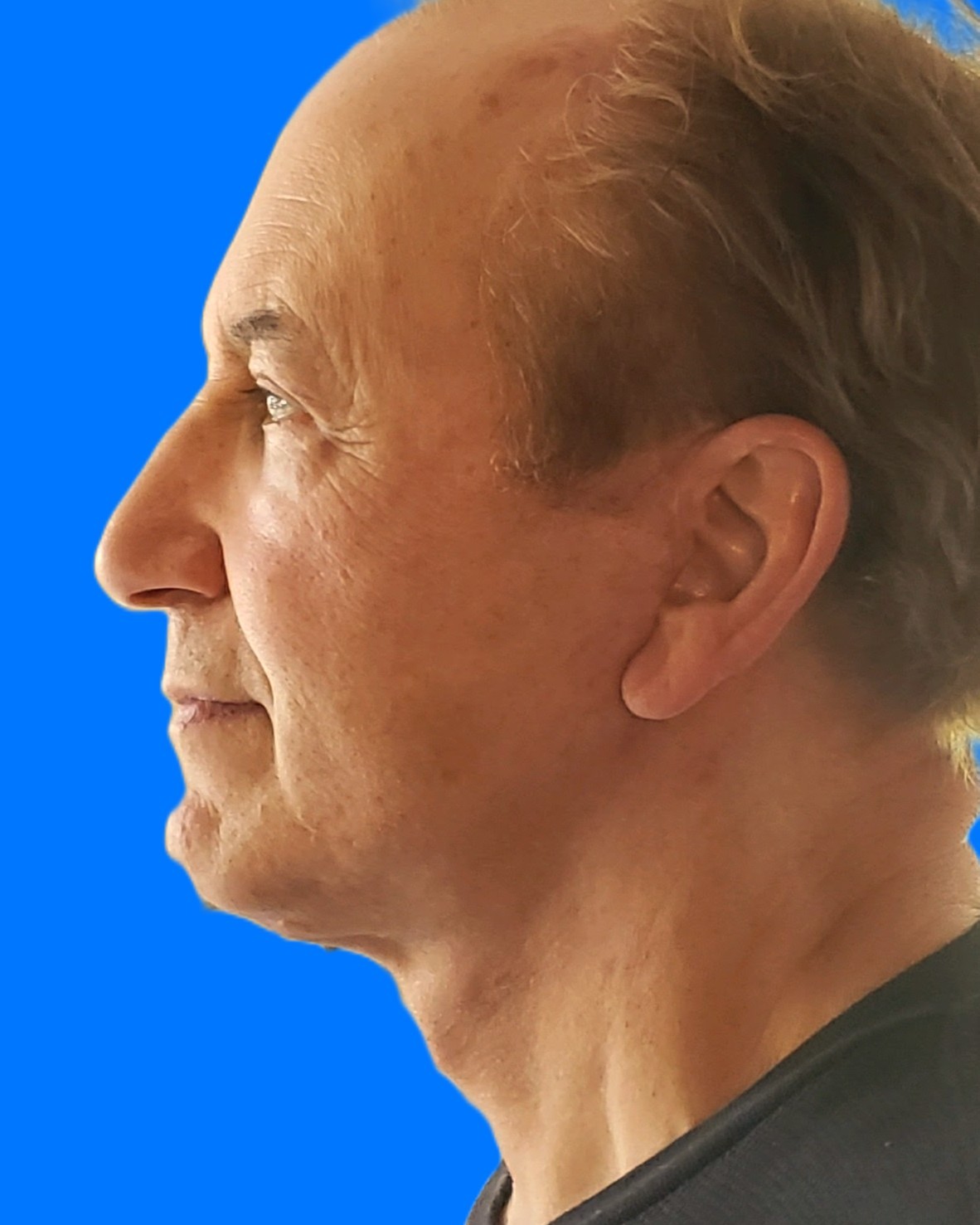 After Image: Patient Case #9250 - left-side