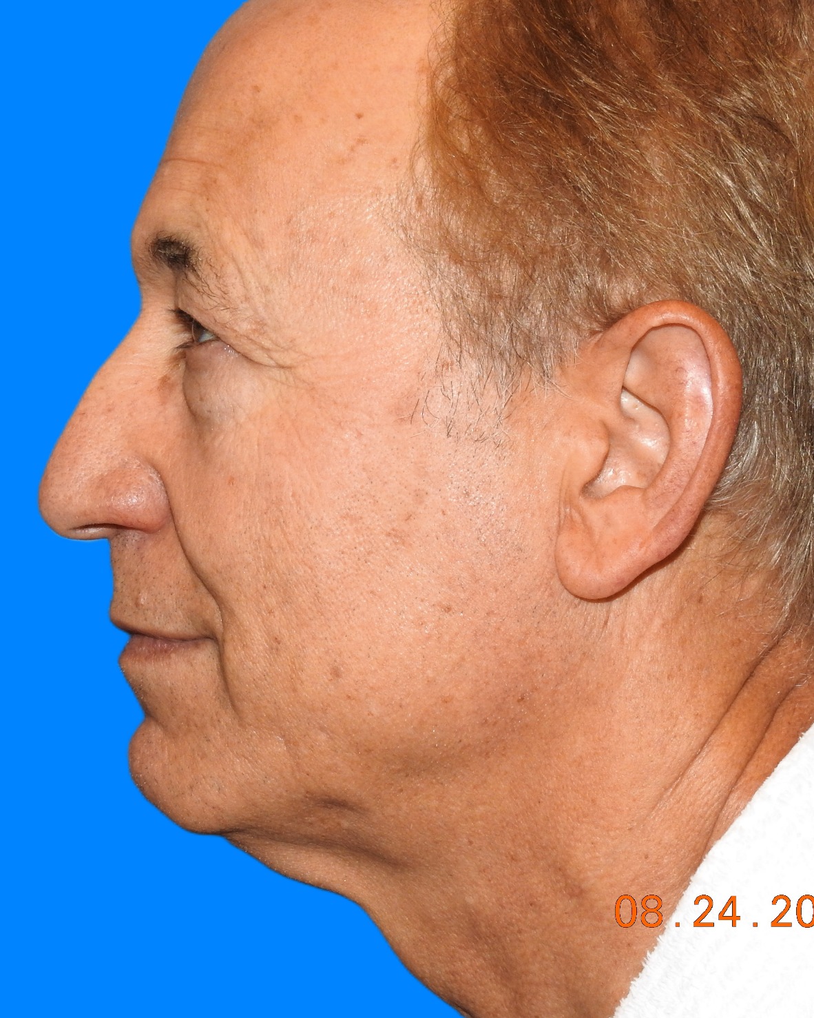 Before Image: Patient Case #9250 - left-side