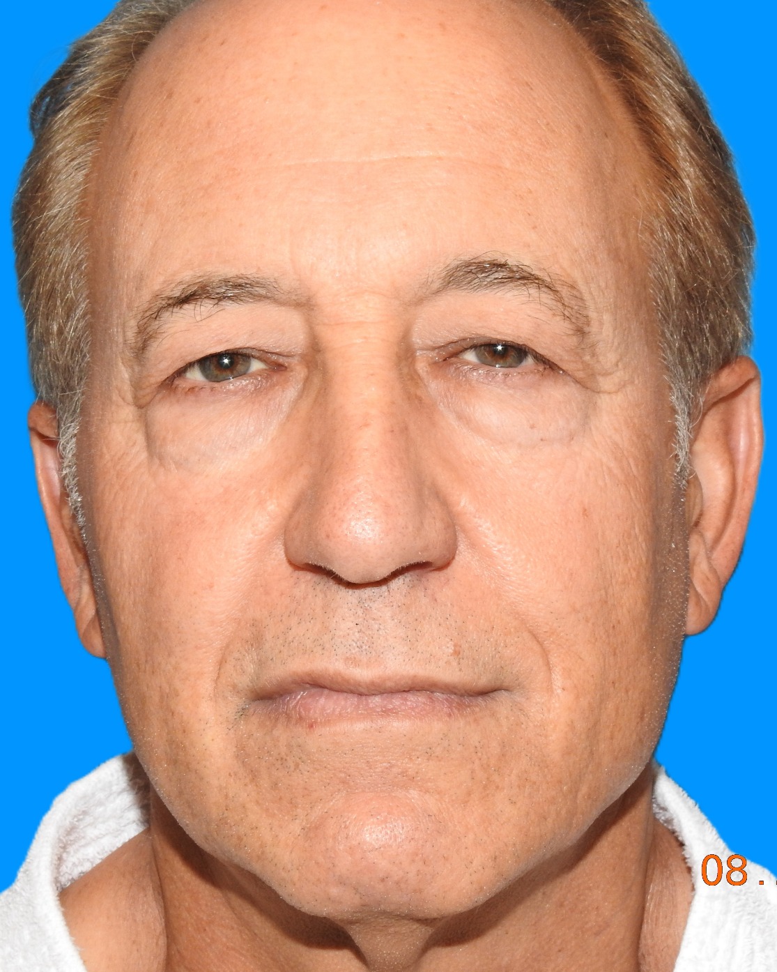 Before Image: Patient Case #9250 - front