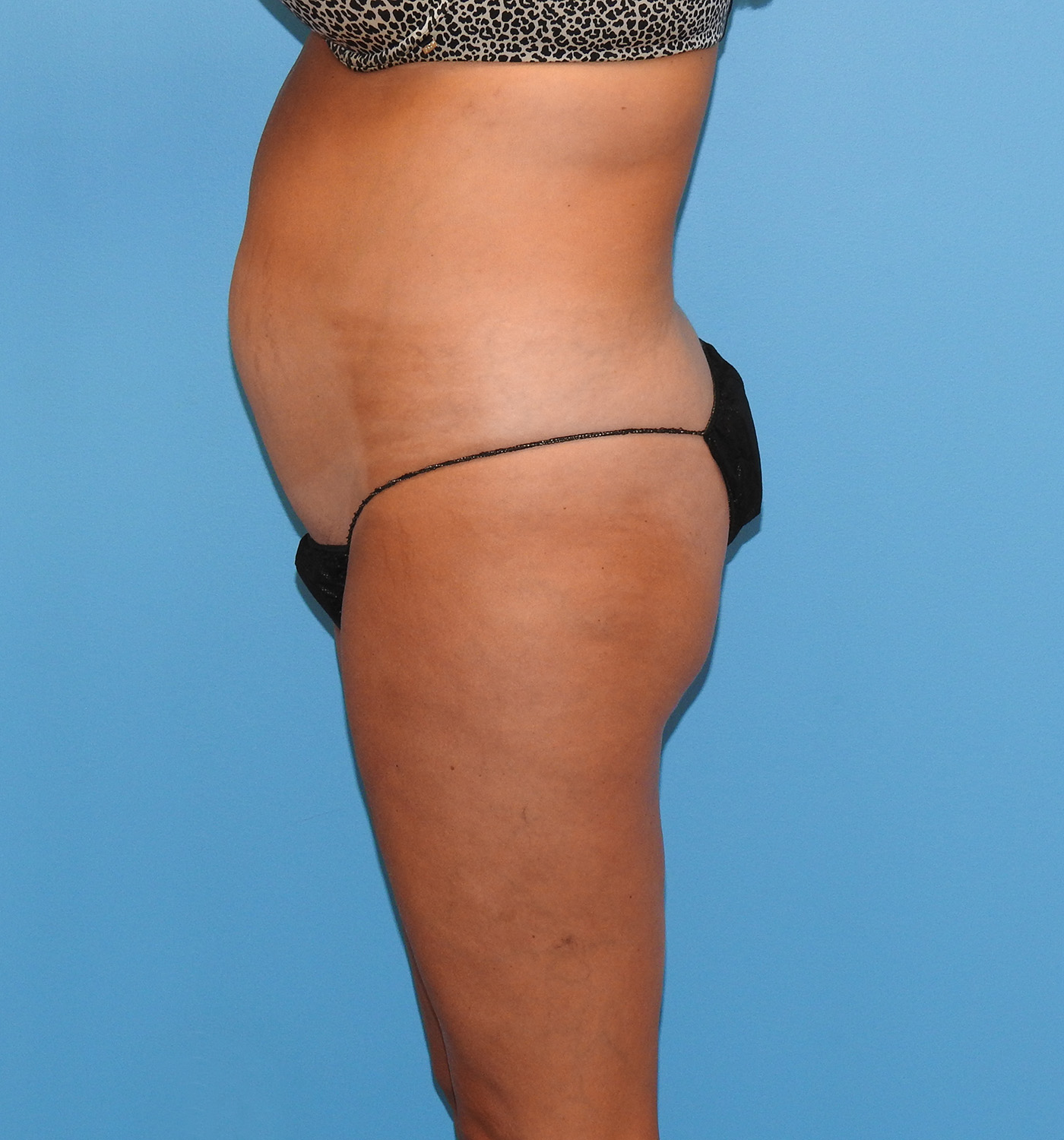 Before Image: Patient Case #9293 - left-side