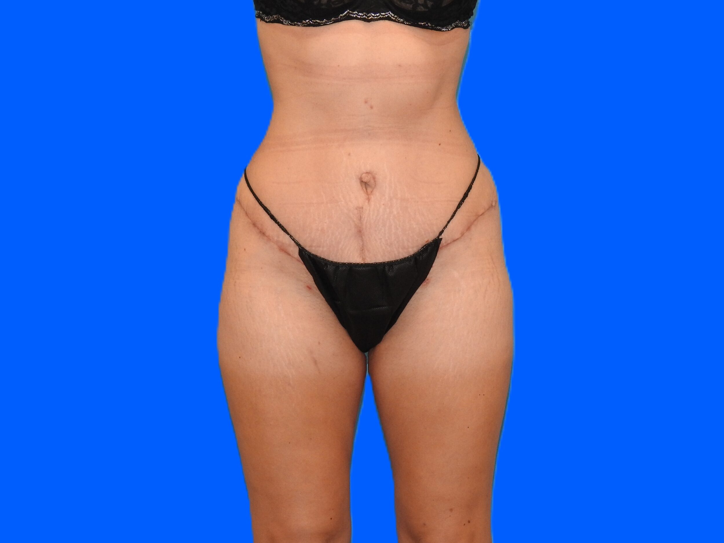 After Image: Patient Case #9298 - front