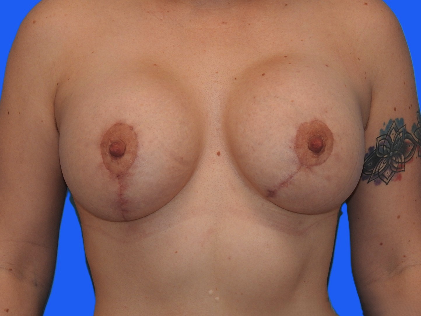 After Image: Patient Case #9298 - front