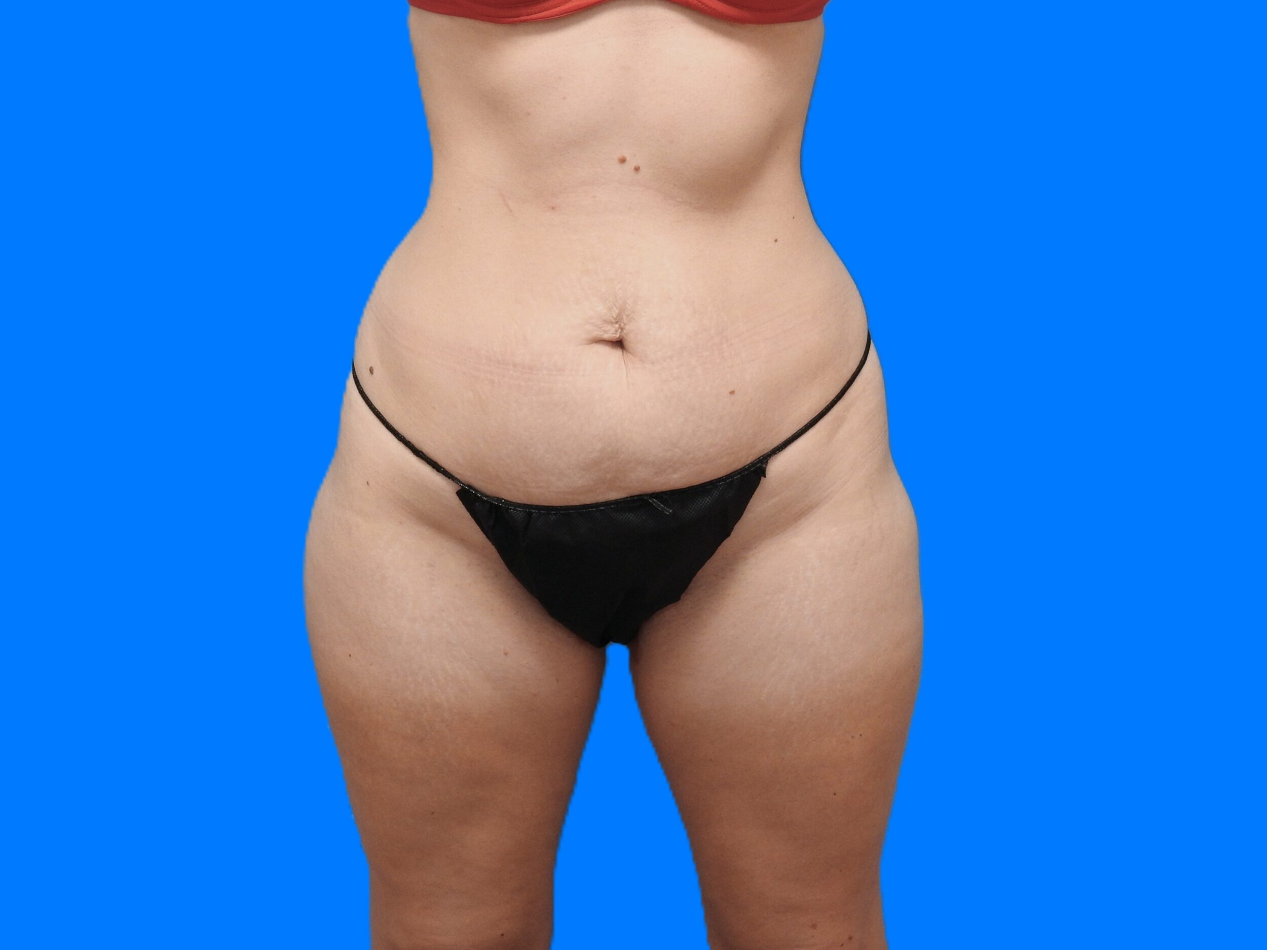 Before Image: Patient Case #9298 - front