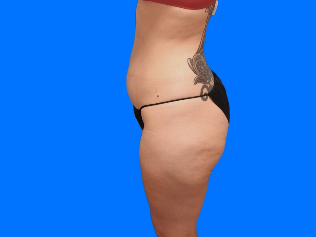 Before Image: Patient Case #9298 - left-side