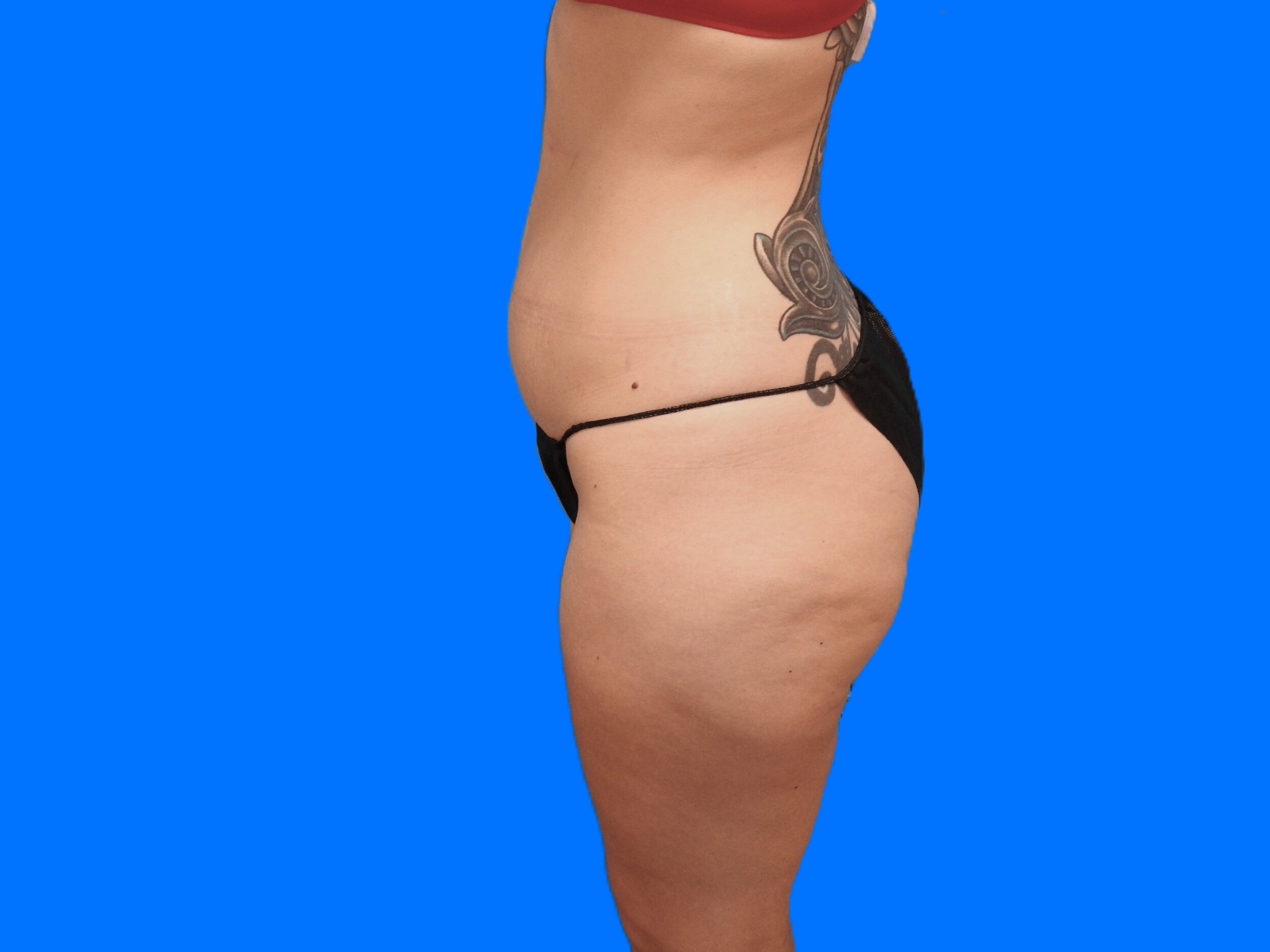 Before Image: Patient Case #9298 - left-side