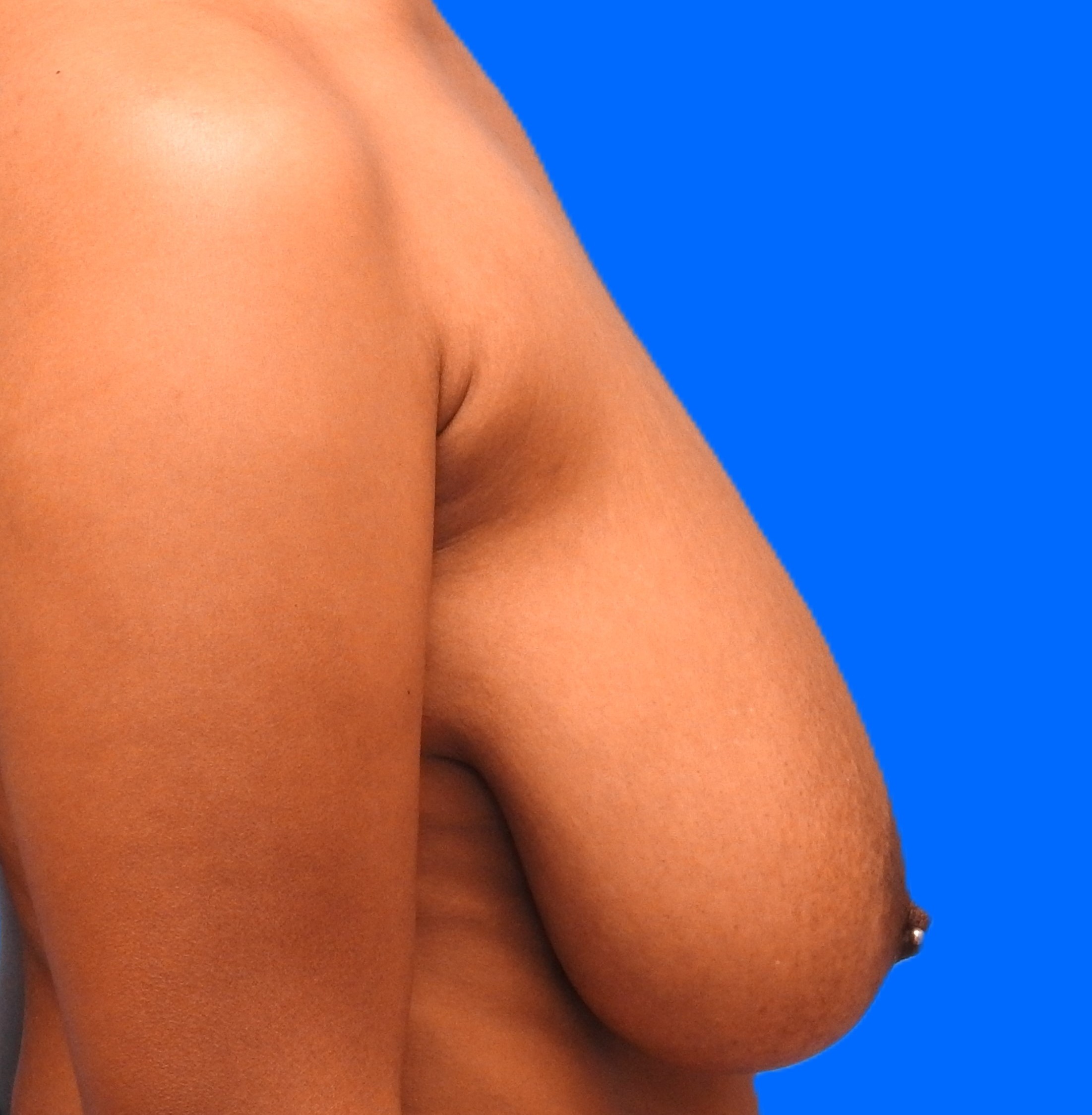 Before Image: Patient Case #9360 - right-side