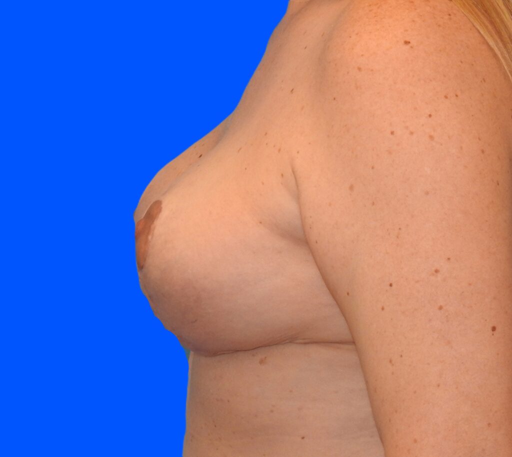 After Image: Patient Case #9361 - left-side