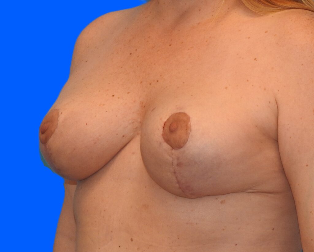 After Image: Patient Case #9361 - left-front-oblique