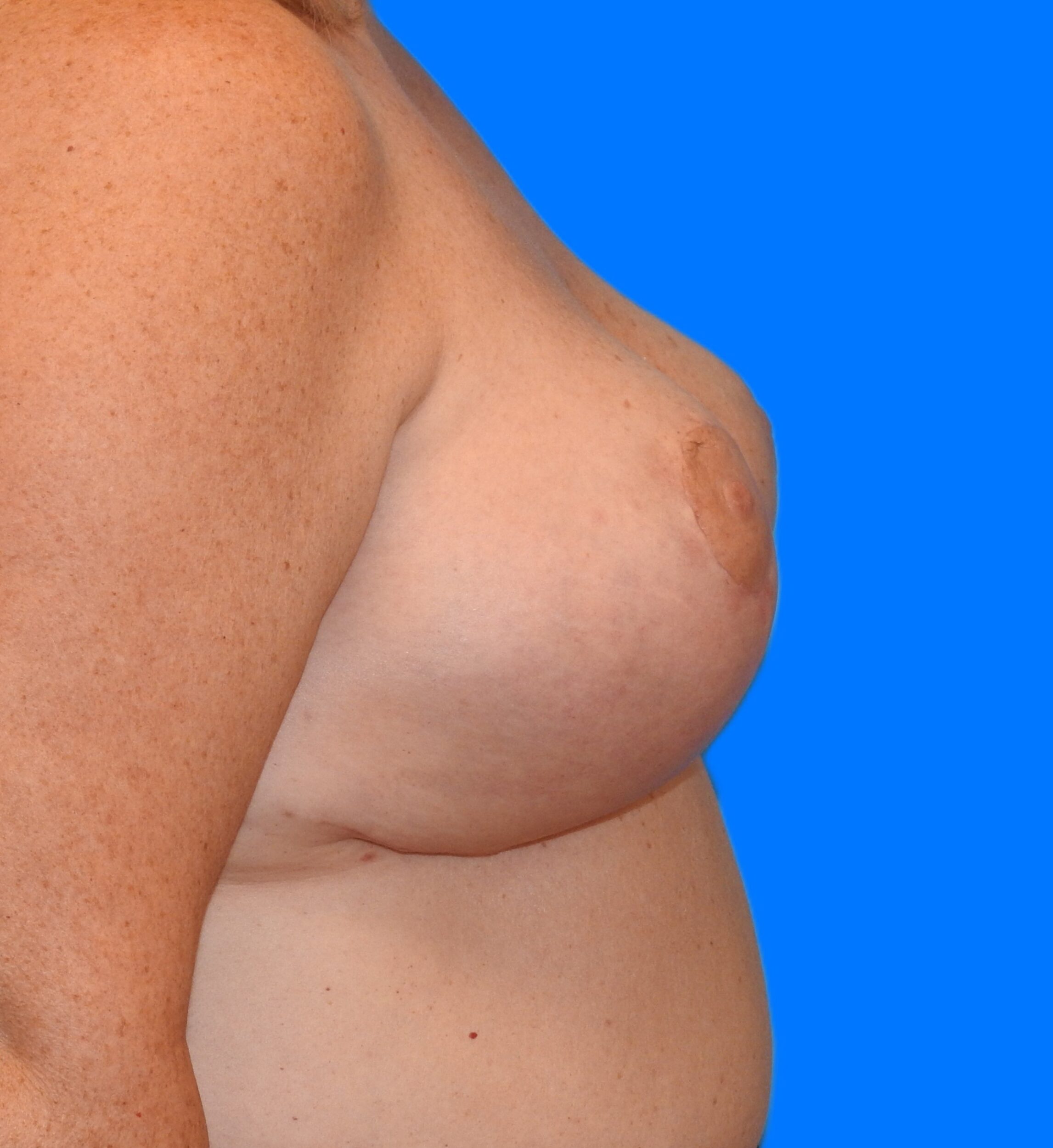 After Image: Patient Case #9362 - right-side