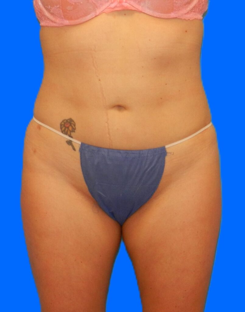 After Image: Patient Case #976 - front