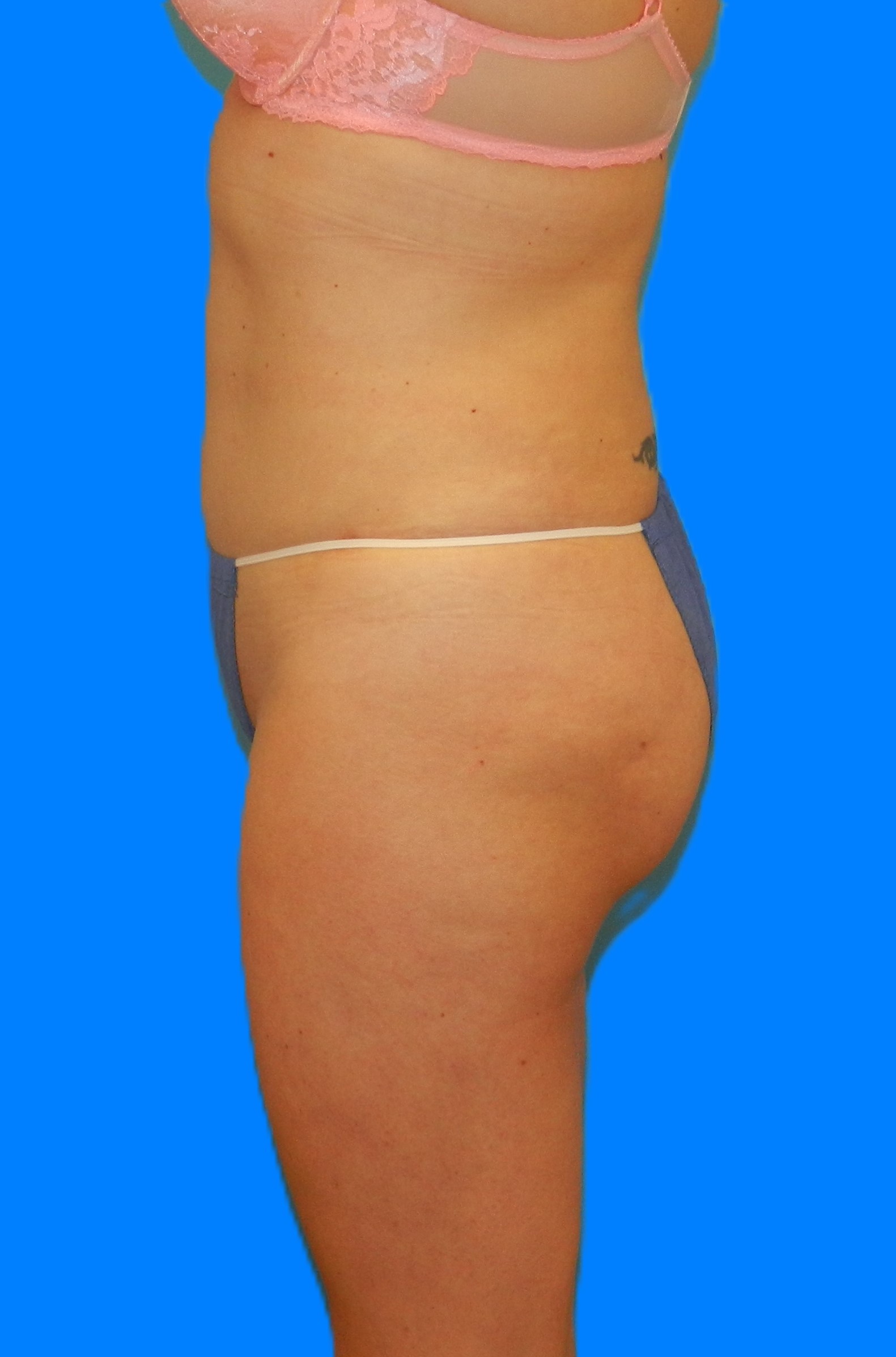 After Image: Patient Case #976 - left-side