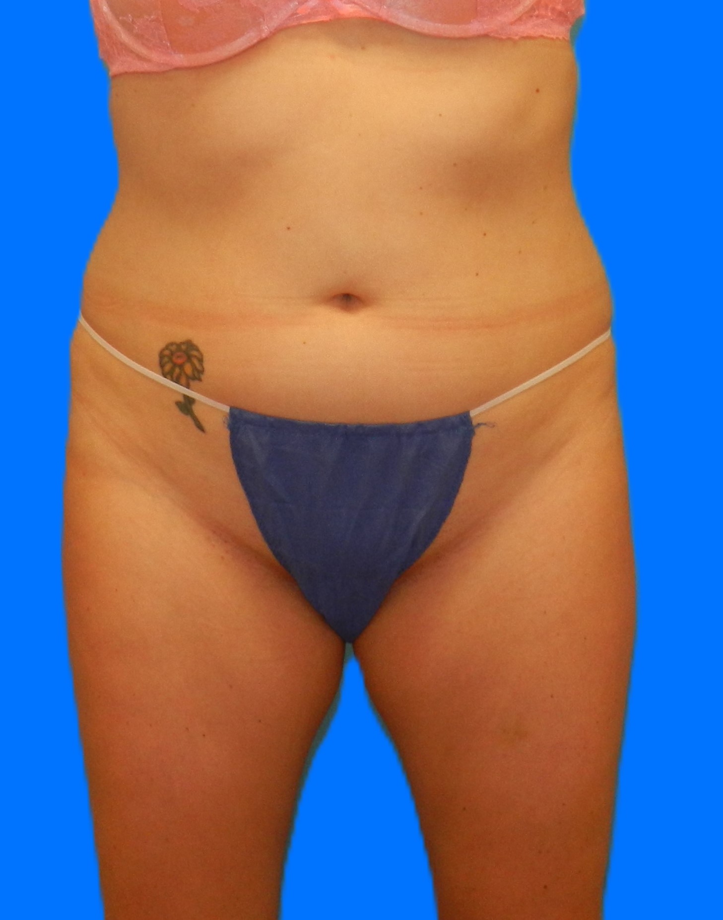 Before Image: Patient Case #976 - front