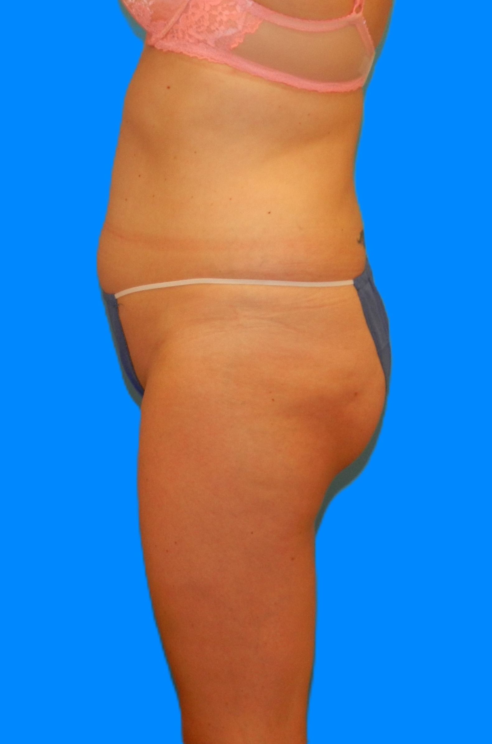 Before Image: Patient Case #976 - left-side