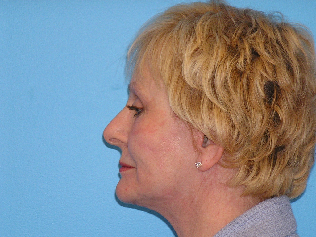 After Image: Patient Case #0122 - left-side