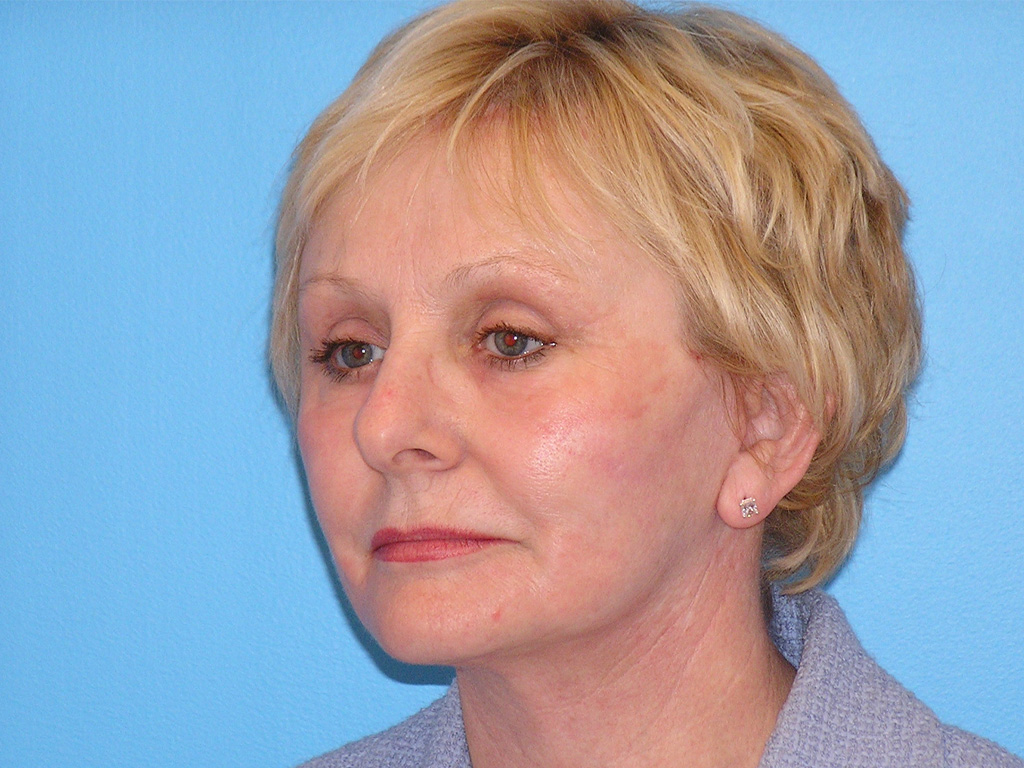 After Image: Patient Case #0122 - left-front-oblique