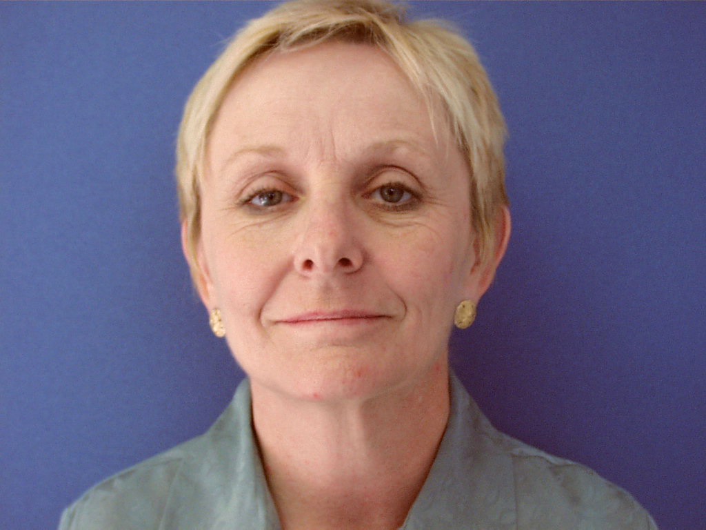 Before Image: Patient Case #0122 - front