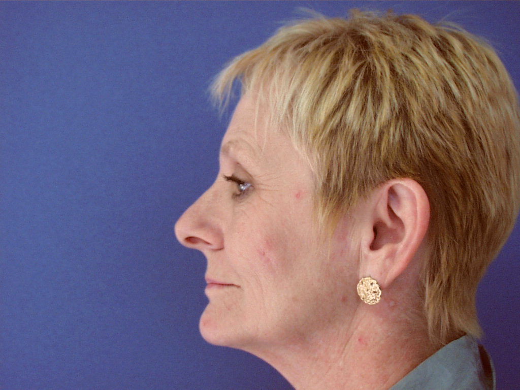 Before Image: Patient Case #0122 - left-side